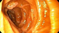 Лимфоидный полип большого сосочка двенадцатиперстной кишки